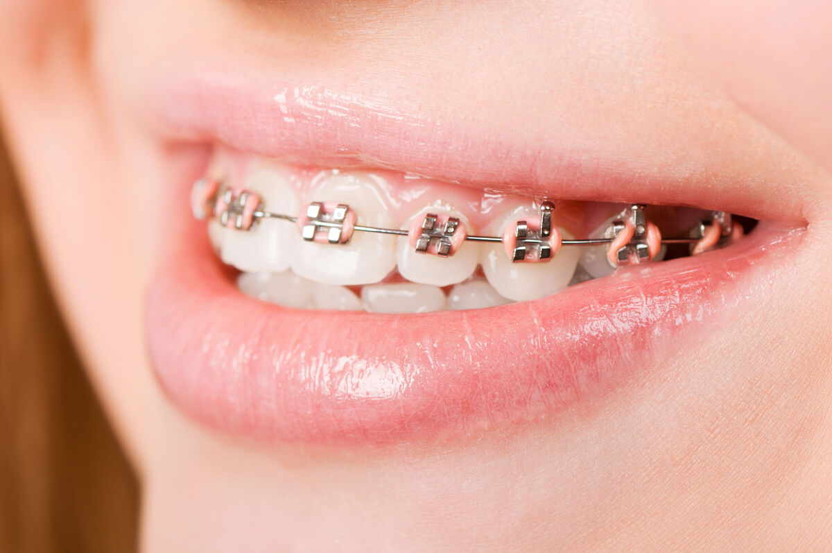 Close-up of traditional metal braces on teeth