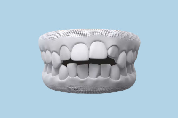 Illustration d'une béance dentaire (open bite)