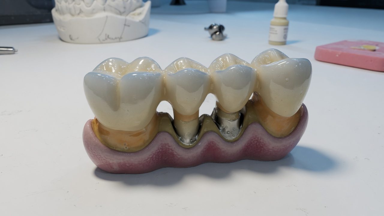 Bridge dentaire trois éléments pour une dent manquante