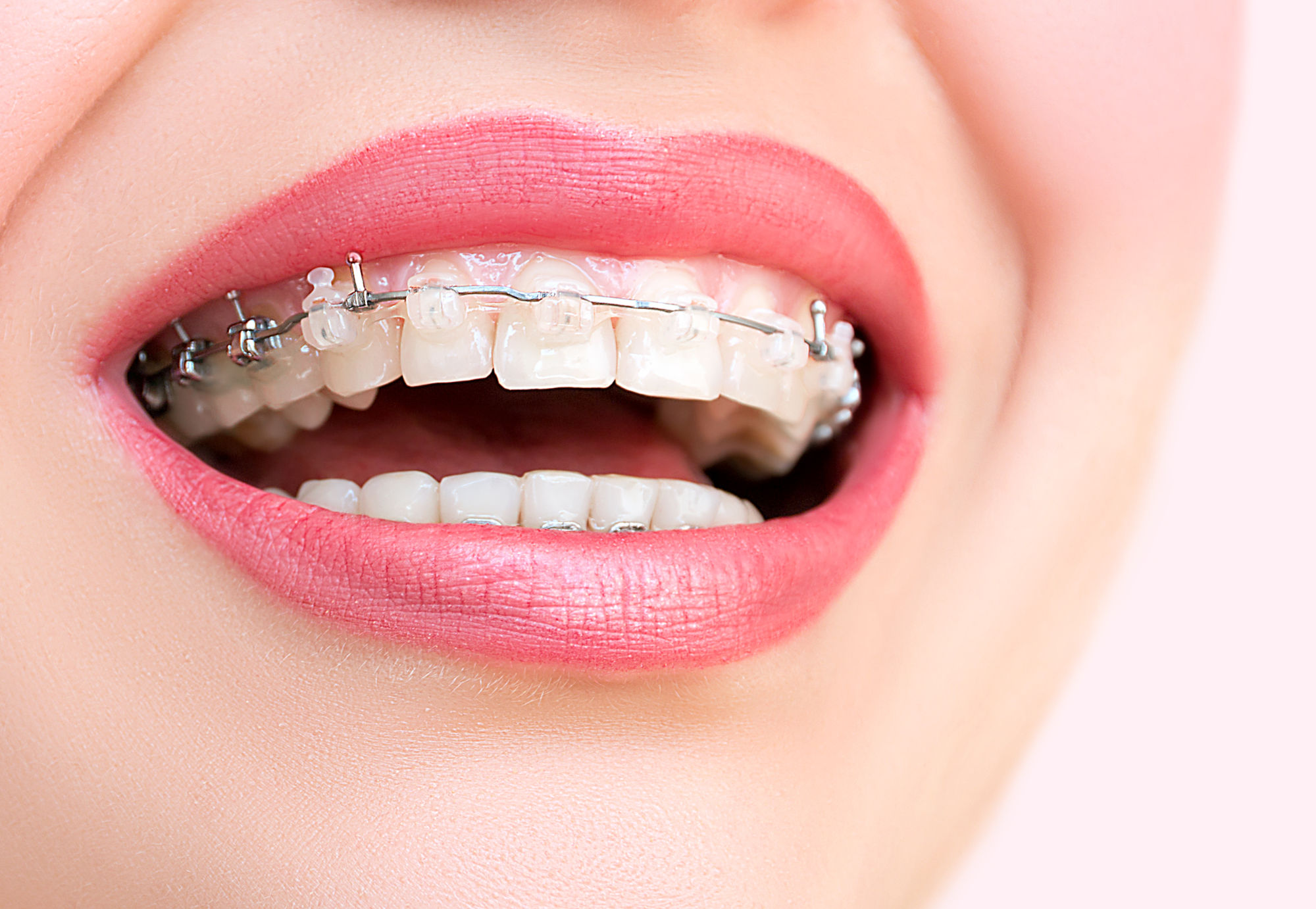 Close-up of ceramic braces on teeth, blending with tooth color