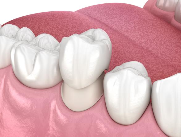 Dent provisoire : types, durée, prix et que faire si elle tombe