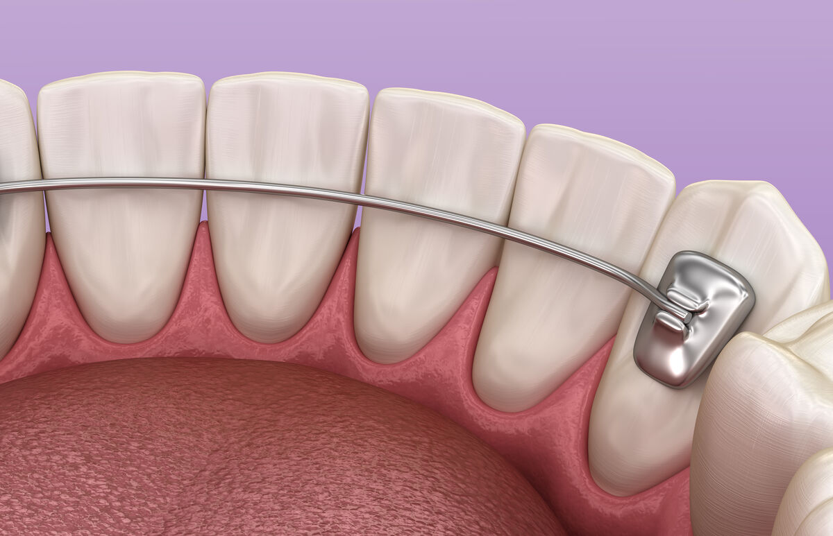 Guide complet sur la contention en orthodontie