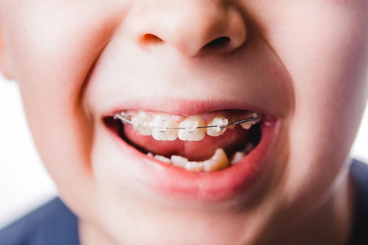 Jeune patient avec malocclusion dentaire traité avec des bagues en céramique