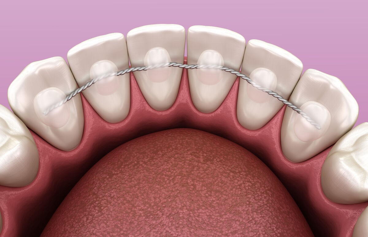 Fil de contention orthodontique discret posé sur la face interne des dents