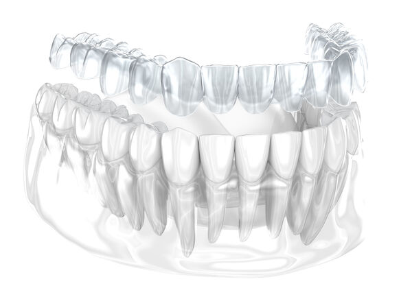 Aligneurs transparents Invisalign