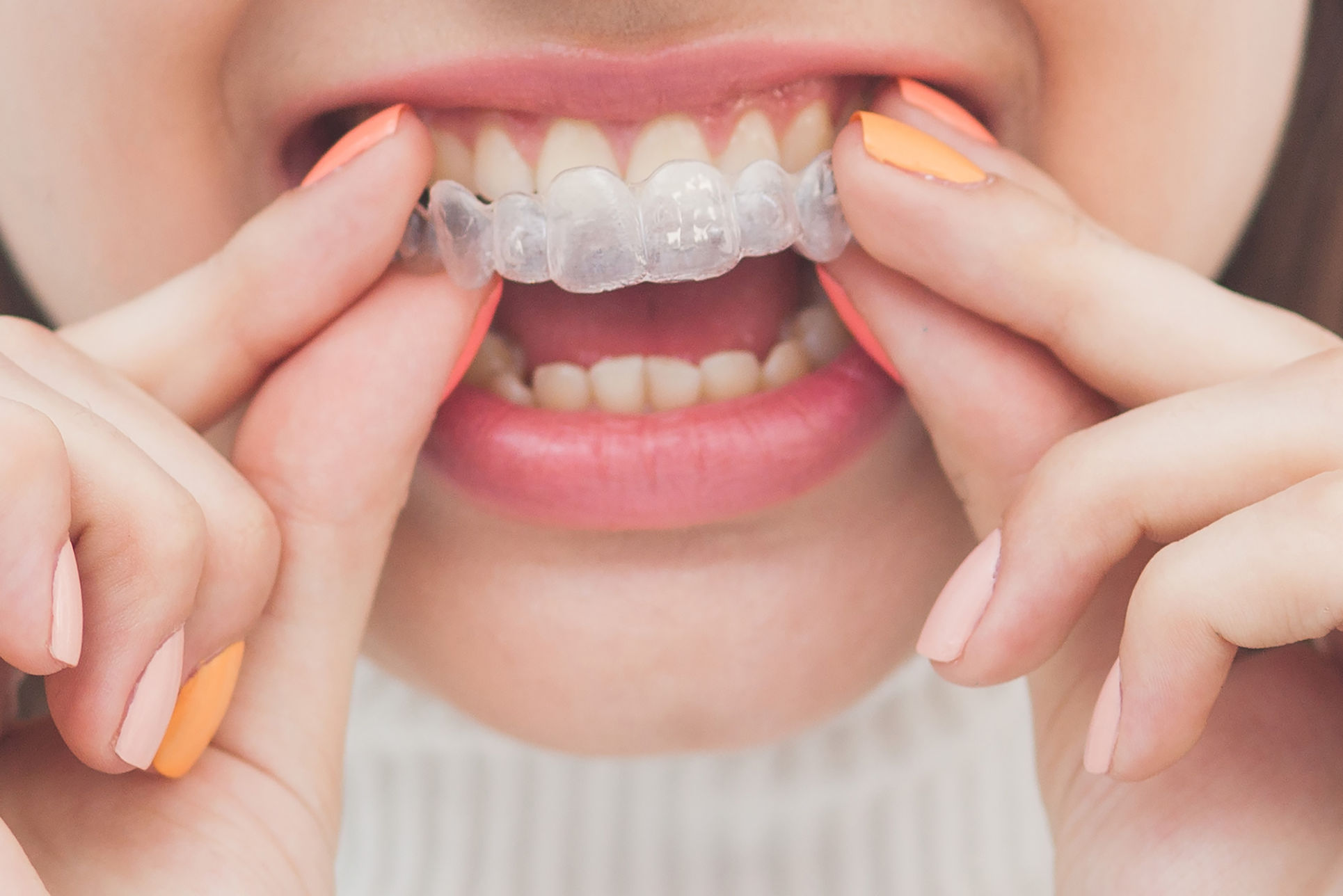 Ma Gouttière Invisalign® ne rentre pas : Que dois-je Faire ?