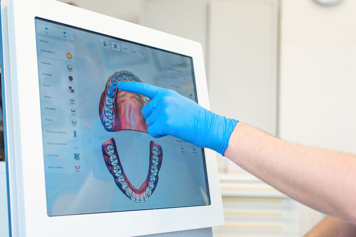 Simulation virtuelle d'un plan de traitement orthodontique par aligneurs