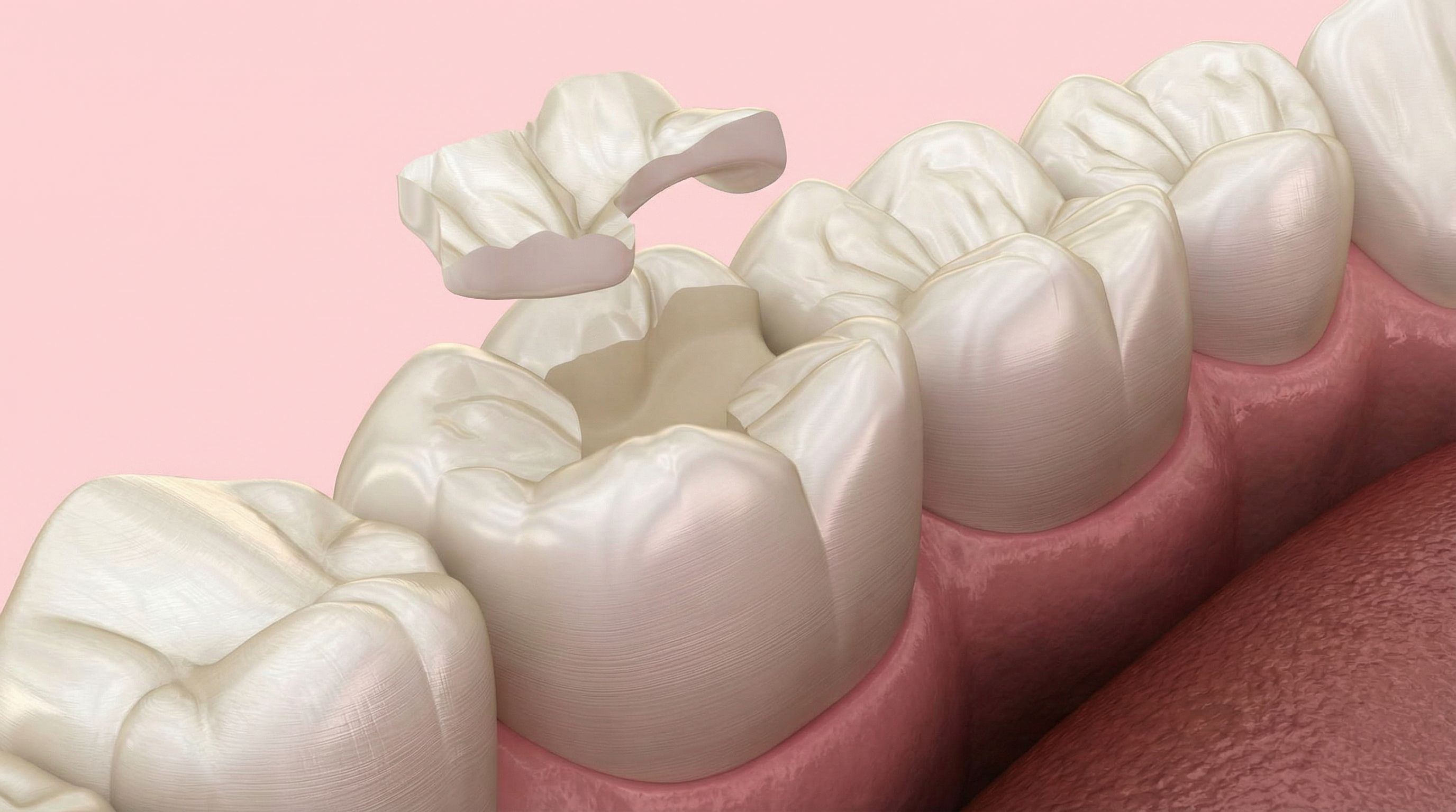 Inlay Onlay : Guide Complet sur ces Restaurations Dentaires Durables