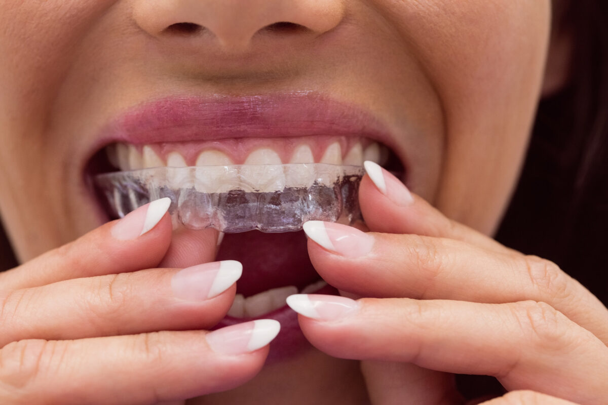 Pose d'une gouttière transparente sur les dents du haut