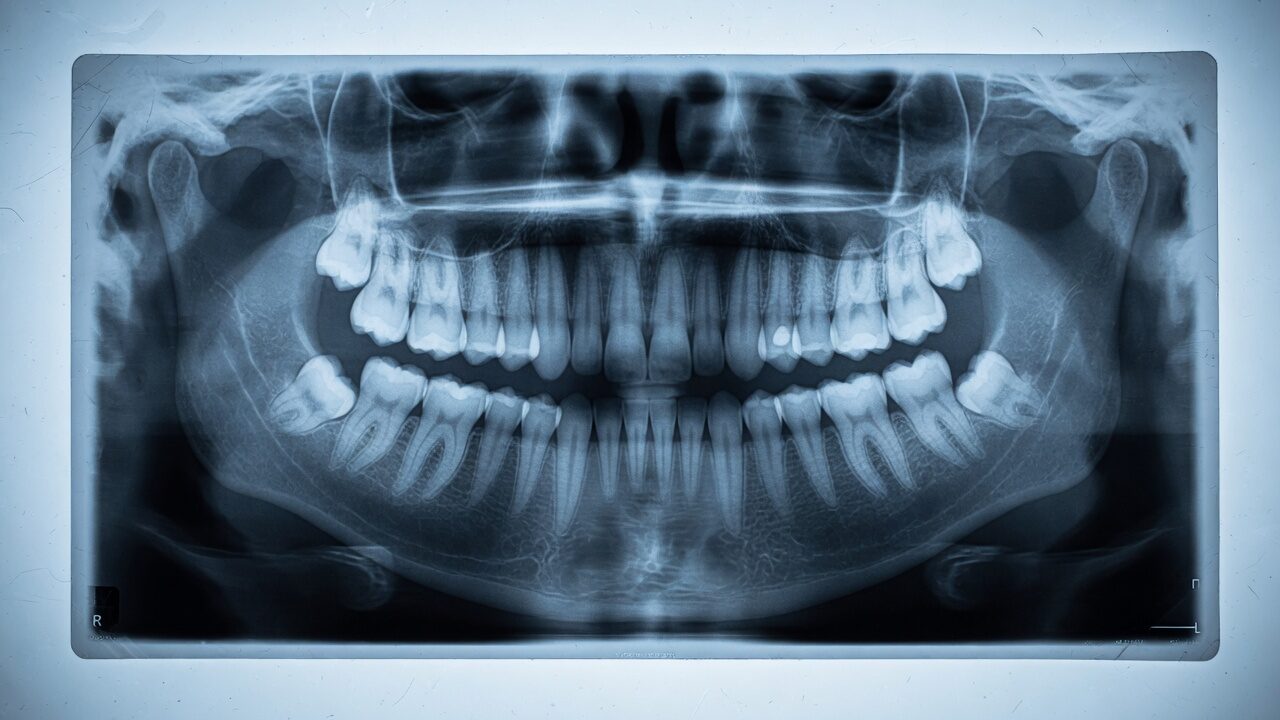 Radiographie panoramique avec dents de sagesse incluses