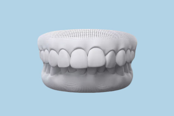 Illustration d'un recouvrement dentaire excessif (overbite)