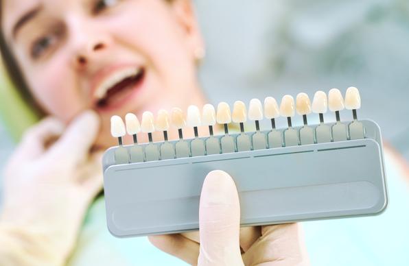 Différentes teintes des implants ou du processus de blanchiment des dents