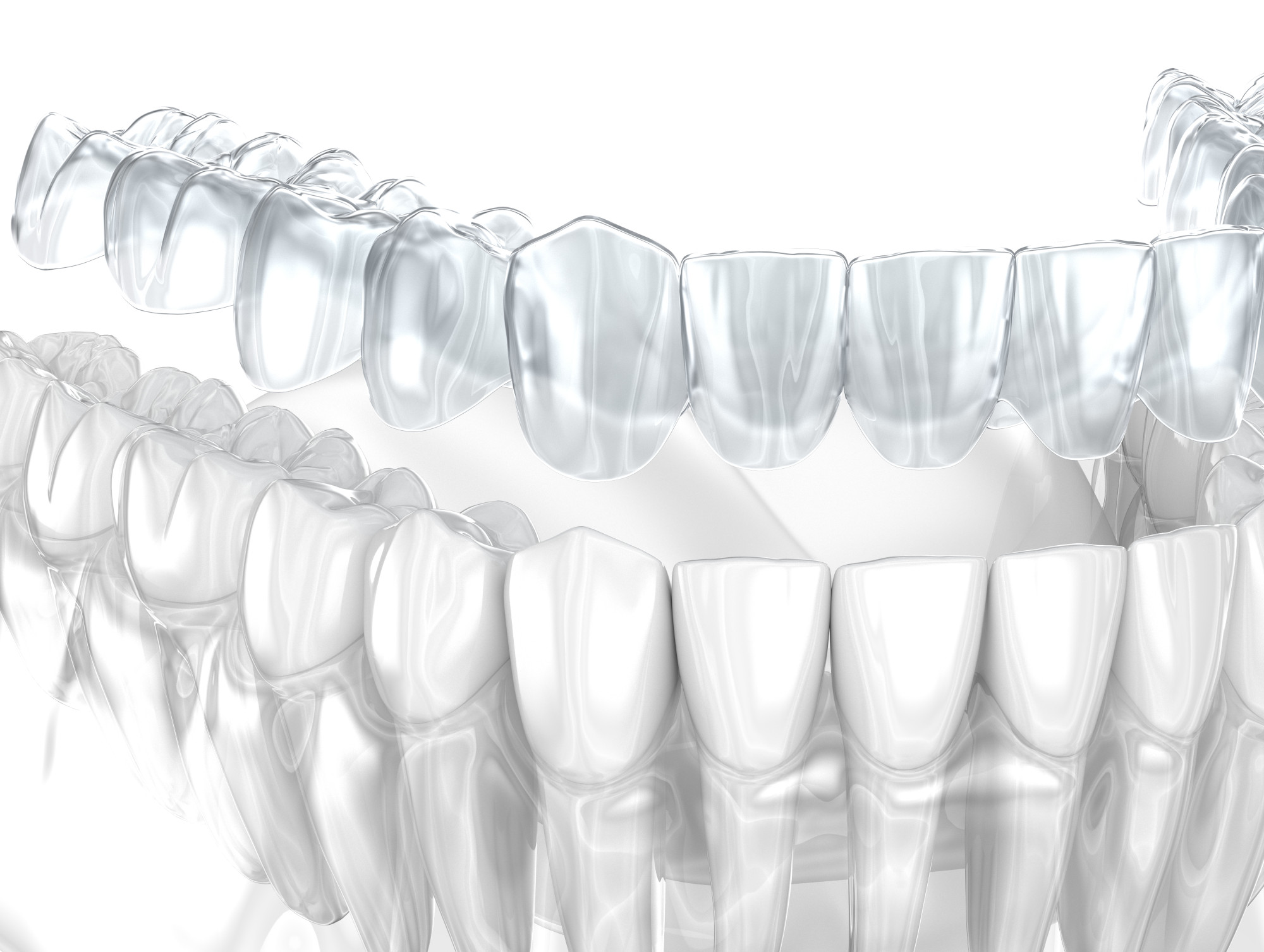 Gouttières Invisalign Transparentes