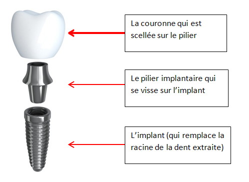 La restauration implantaire unitaire