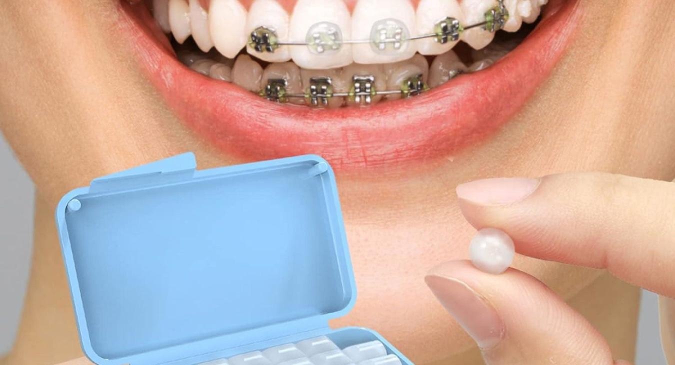 Cire orthodontique : peux-t'on manger avec