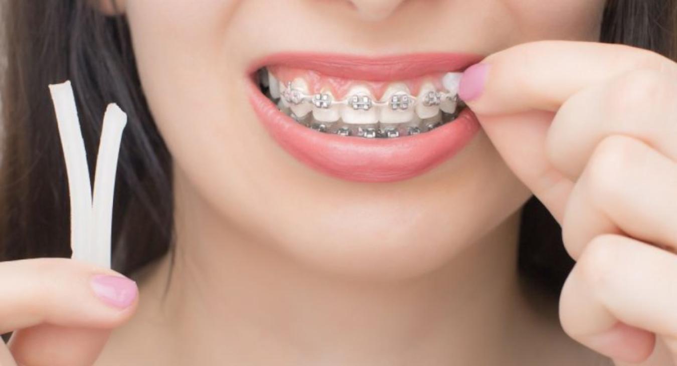 Cire orthodontique : conseils pour la choisir et l’utiliser correctement