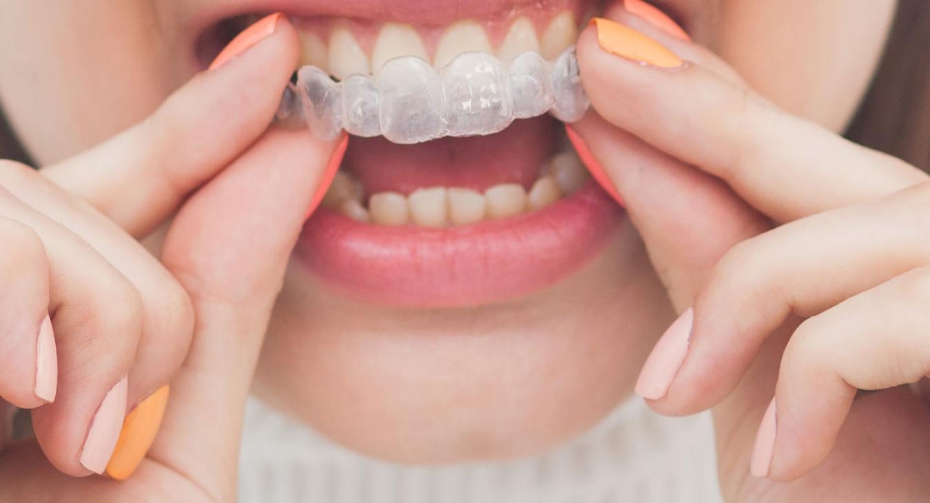 Ma Gouttière Invisalign® ne rentre pas : Que dois-je Faire ?