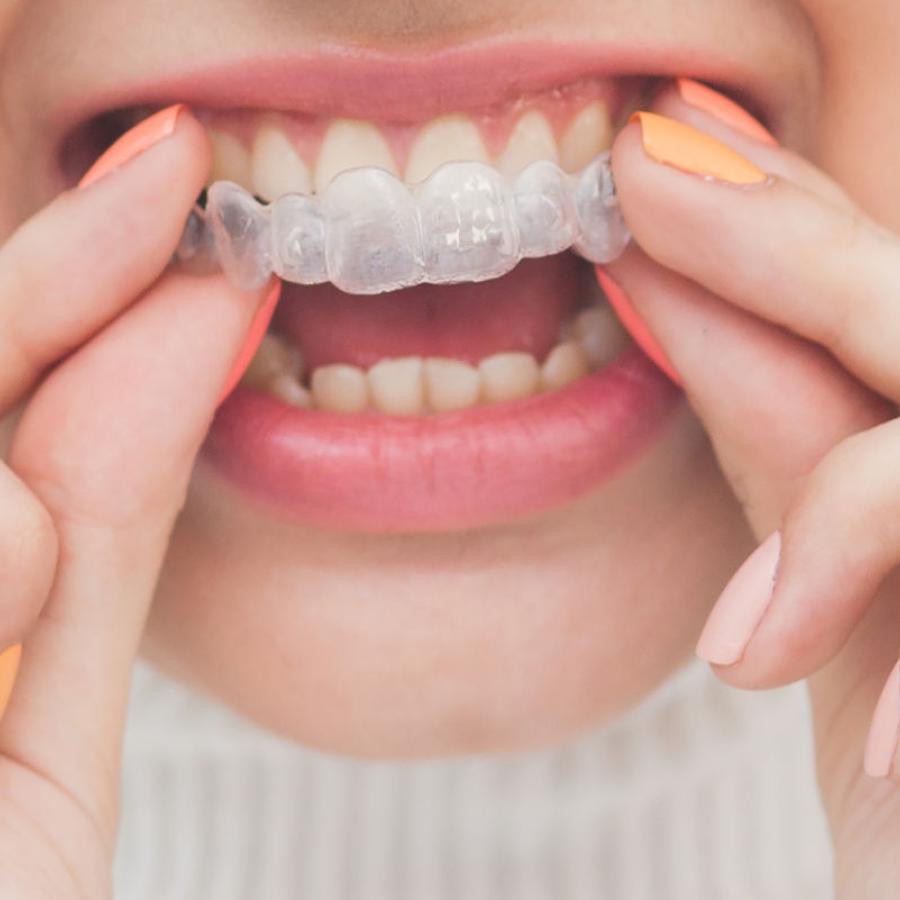 Ma Gouttière Invisalign® ne rentre pas : Que dois-je Faire ?